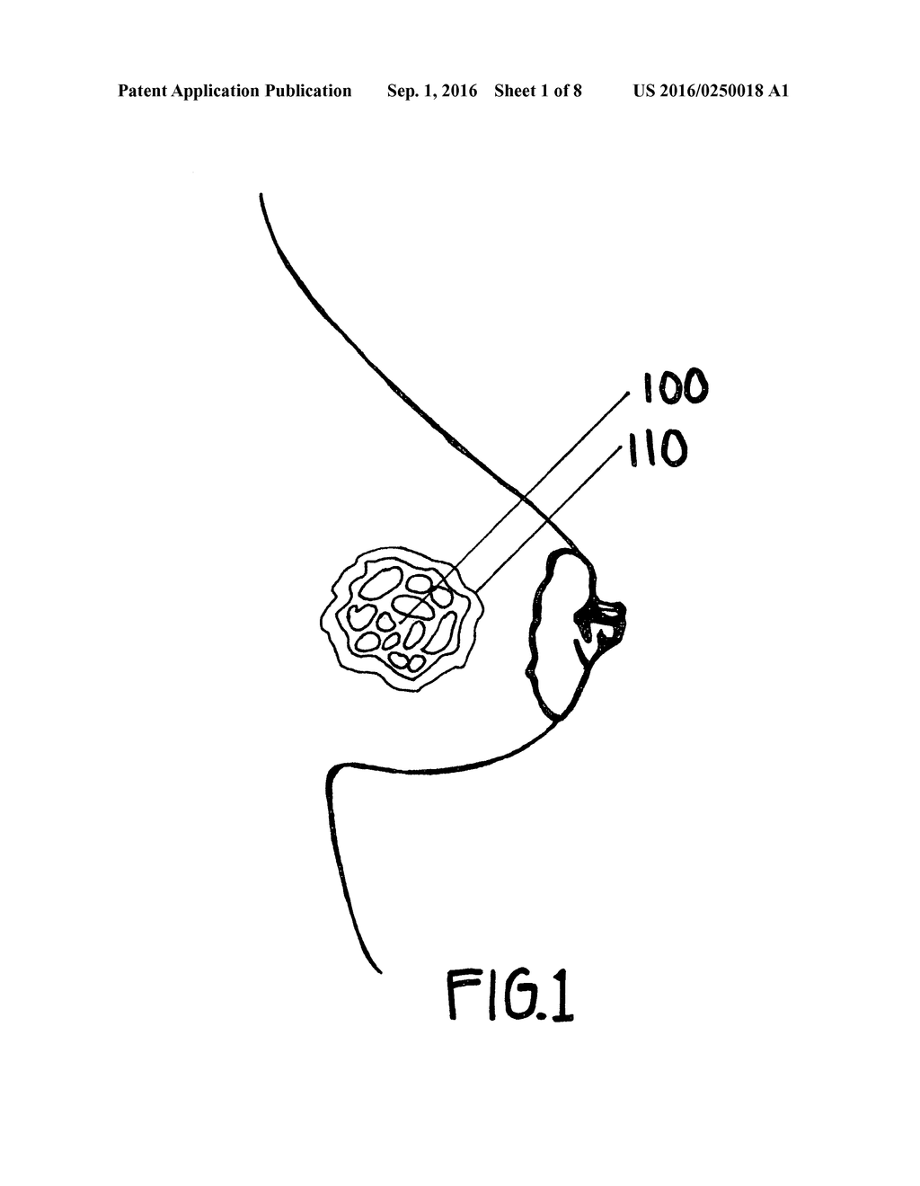 METHOD FOR UTILIZING AN IMPLANT IN A BODY OF A PATIENT - diagram, schematic, and image 02