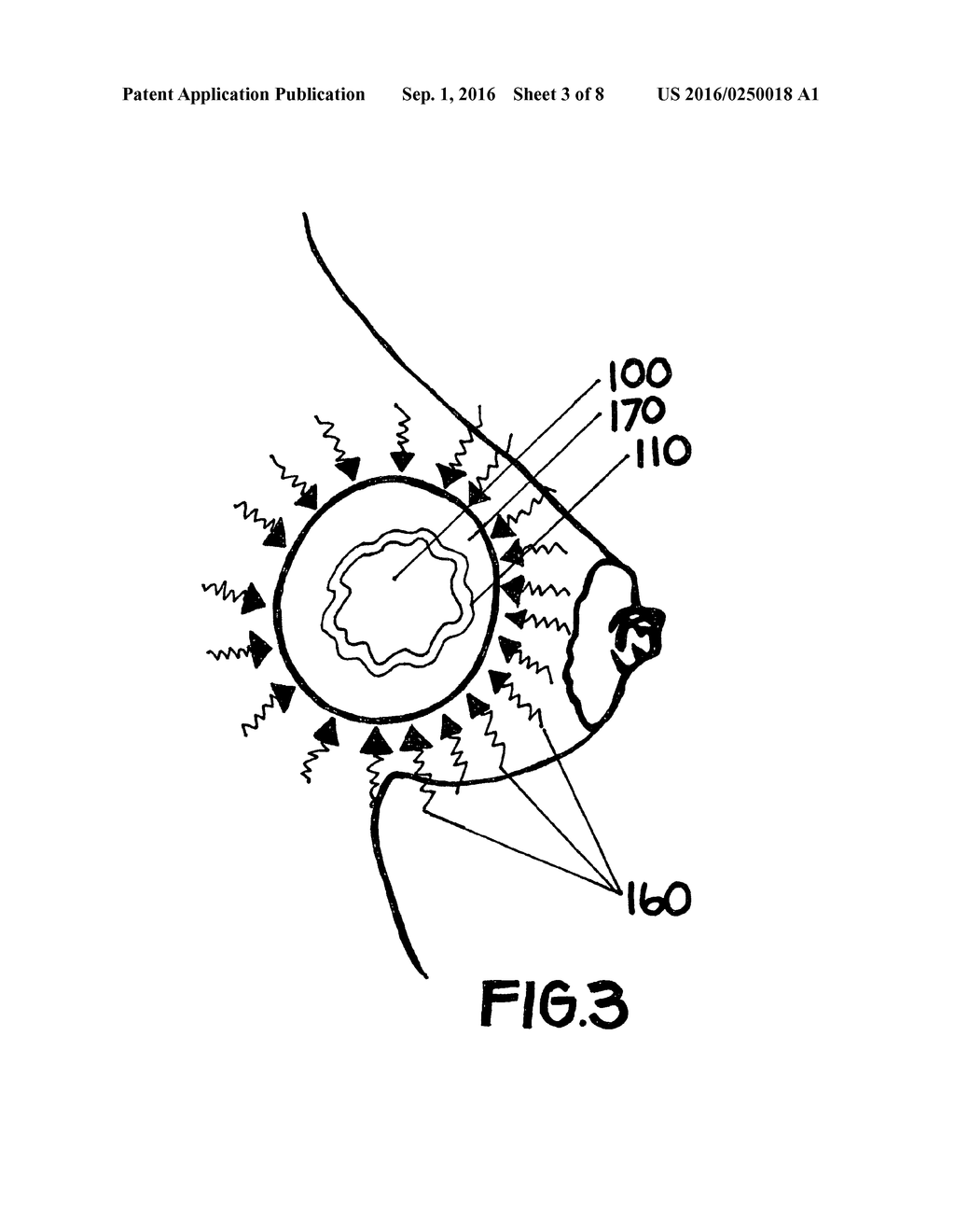 METHOD FOR UTILIZING AN IMPLANT IN A BODY OF A PATIENT - diagram, schematic, and image 04