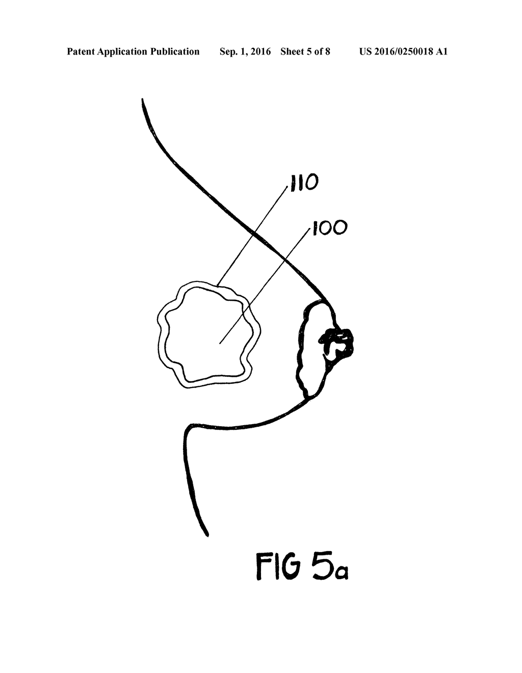 METHOD FOR UTILIZING AN IMPLANT IN A BODY OF A PATIENT - diagram, schematic, and image 06