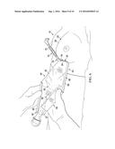 Inverse Bellow Insertion Device diagram and image