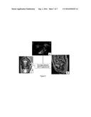 CERCLAGE PESSARY CONTAINING PROGESTERONE OF PROLONGED, SUSTAINED, AND     CONTINUOUS RELEASE USEFUL FOR PREVENTION OF PRETERM BIRTH diagram and image