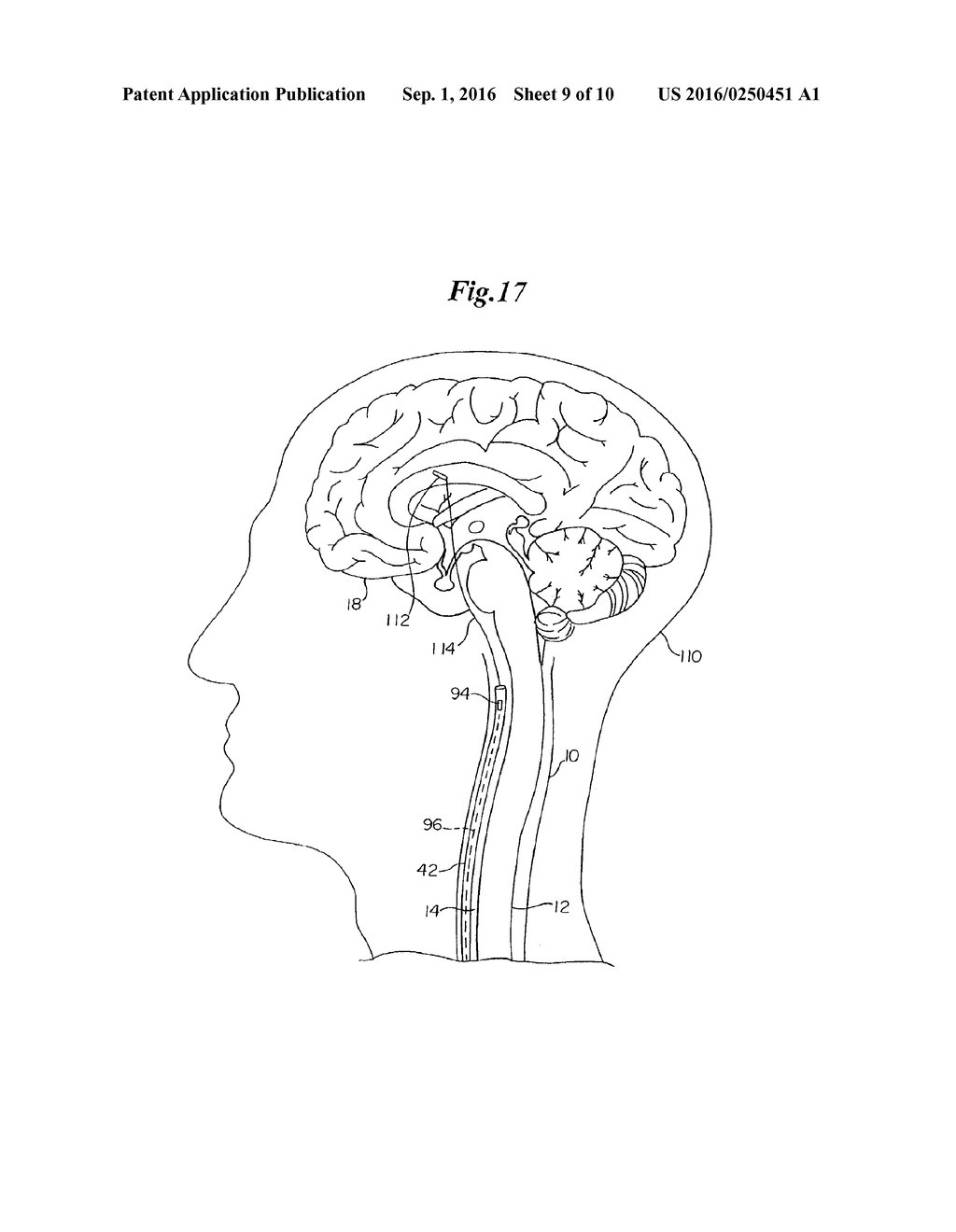 METHODS OF USING A DUAL-LUMEN SHEATH IN INTRALUMINAL PROCEDURES - diagram, schematic, and image 10