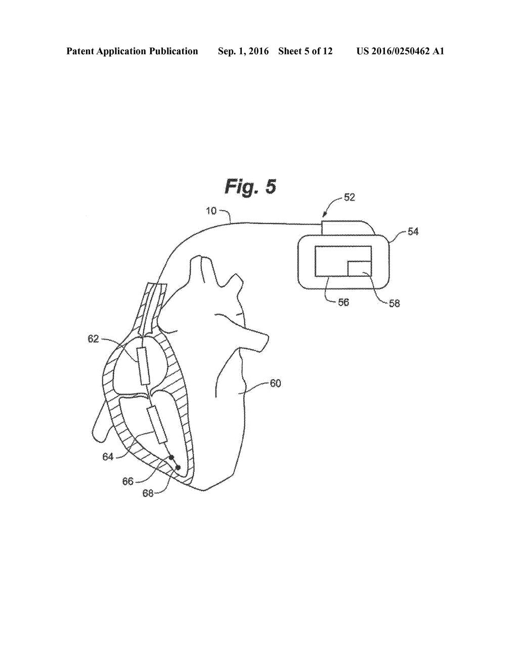 Method for Detecting and Localizing Insulation Failures of Implantable     Device Leads - diagram, schematic, and image 06