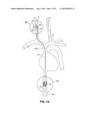 Intravascular Electrode System and Method diagram and image