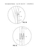 Intravascular Electrode System and Method diagram and image