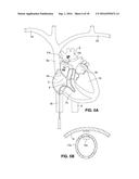 Intravascular Electrode System and Method diagram and image