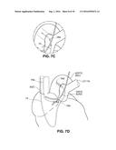 Intravascular Electrode System and Method diagram and image