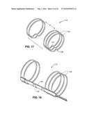 Intravascular Electrode System and Method diagram and image