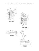 Intravascular Electrode System and Method diagram and image