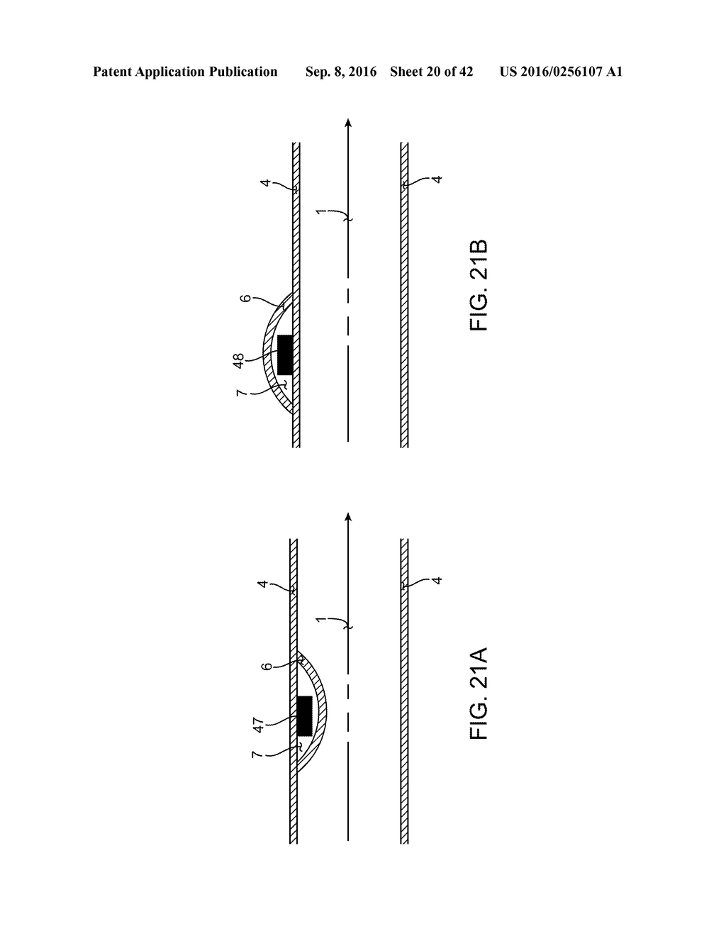 DETECTION OF STENOSIS IN A PROSTHESIS USING BREAK FREQUENCY - diagram, schematic, and image 21