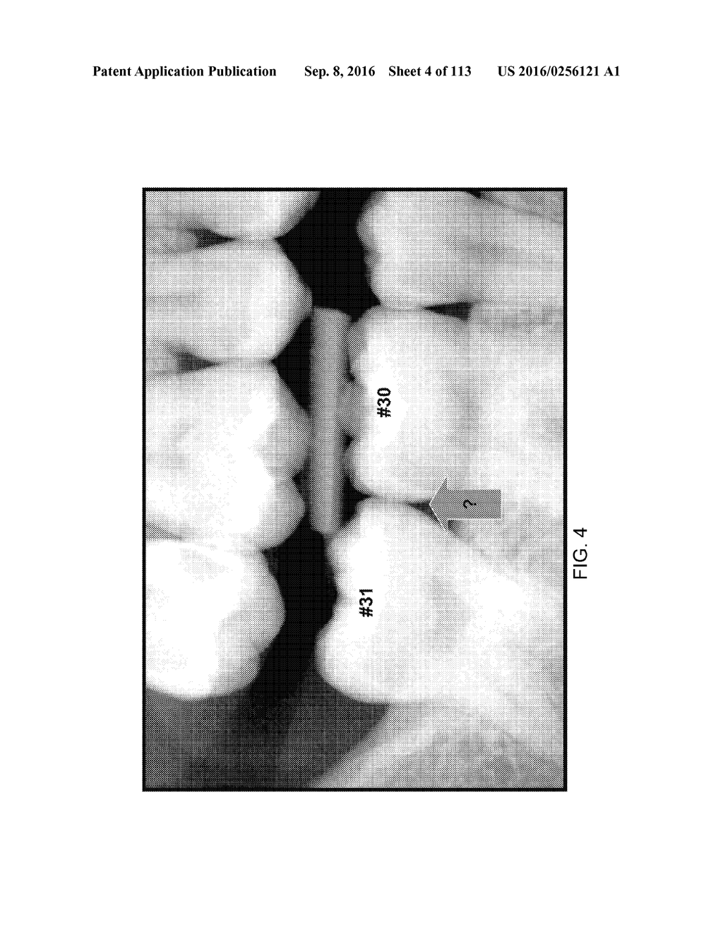 DIGITAL X-RAY DIAGNOSIS AND EVALUATION OF DENTAL DISEASE - diagram, schematic, and image 05