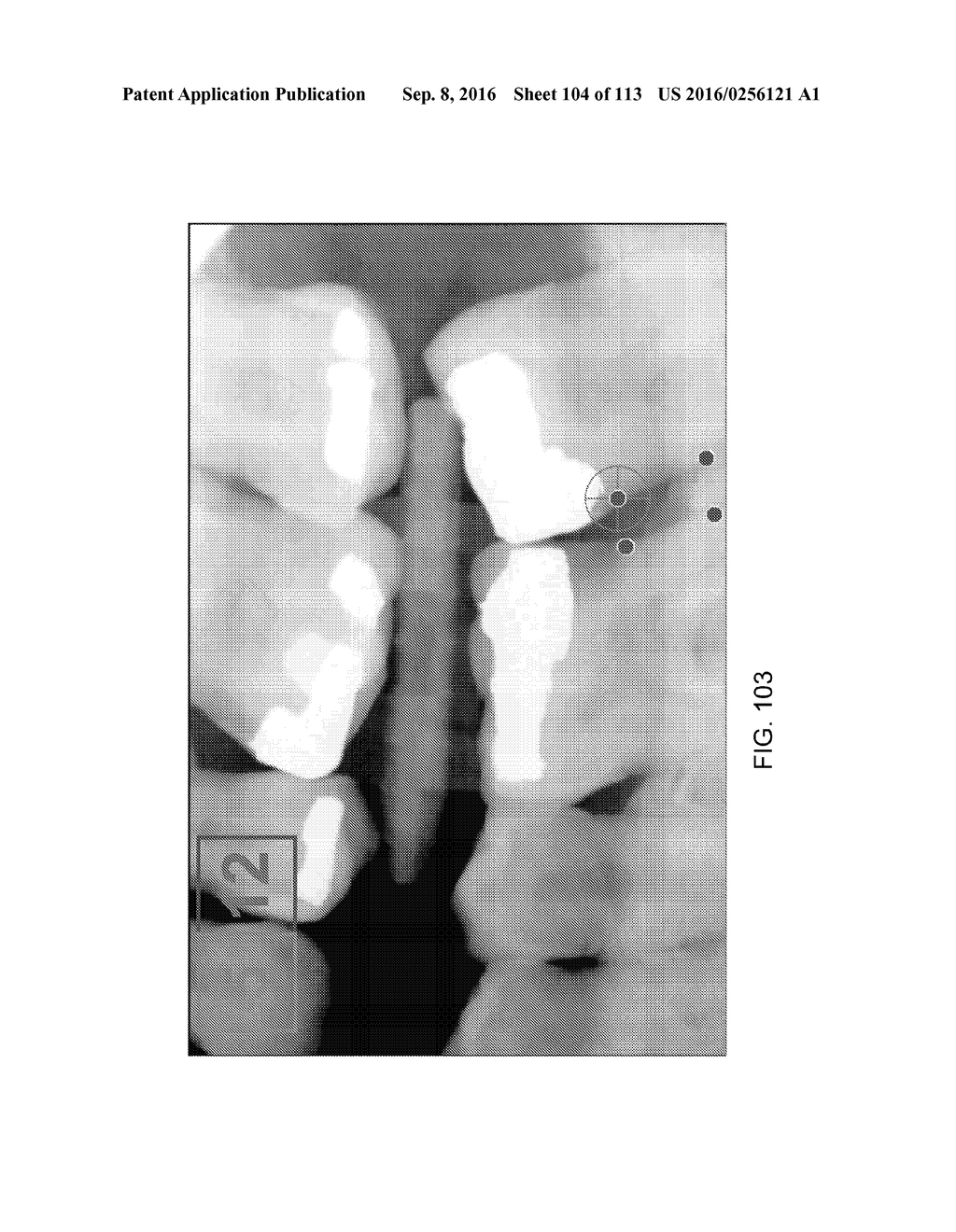 DIGITAL X-RAY DIAGNOSIS AND EVALUATION OF DENTAL DISEASE - diagram, schematic, and image 105