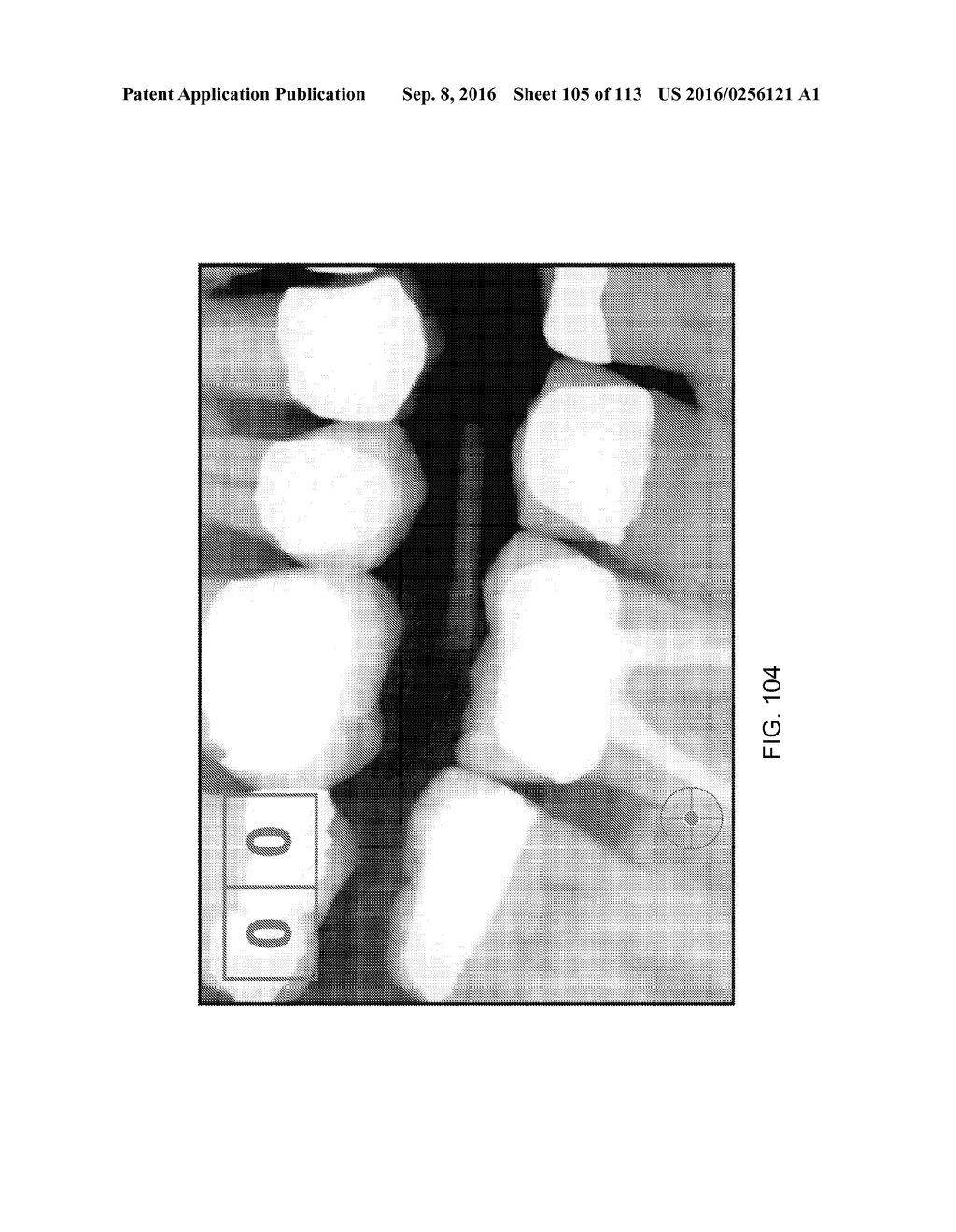 DIGITAL X-RAY DIAGNOSIS AND EVALUATION OF DENTAL DISEASE - diagram, schematic, and image 106