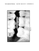 DIGITAL X-RAY DIAGNOSIS AND EVALUATION OF DENTAL DISEASE diagram and image