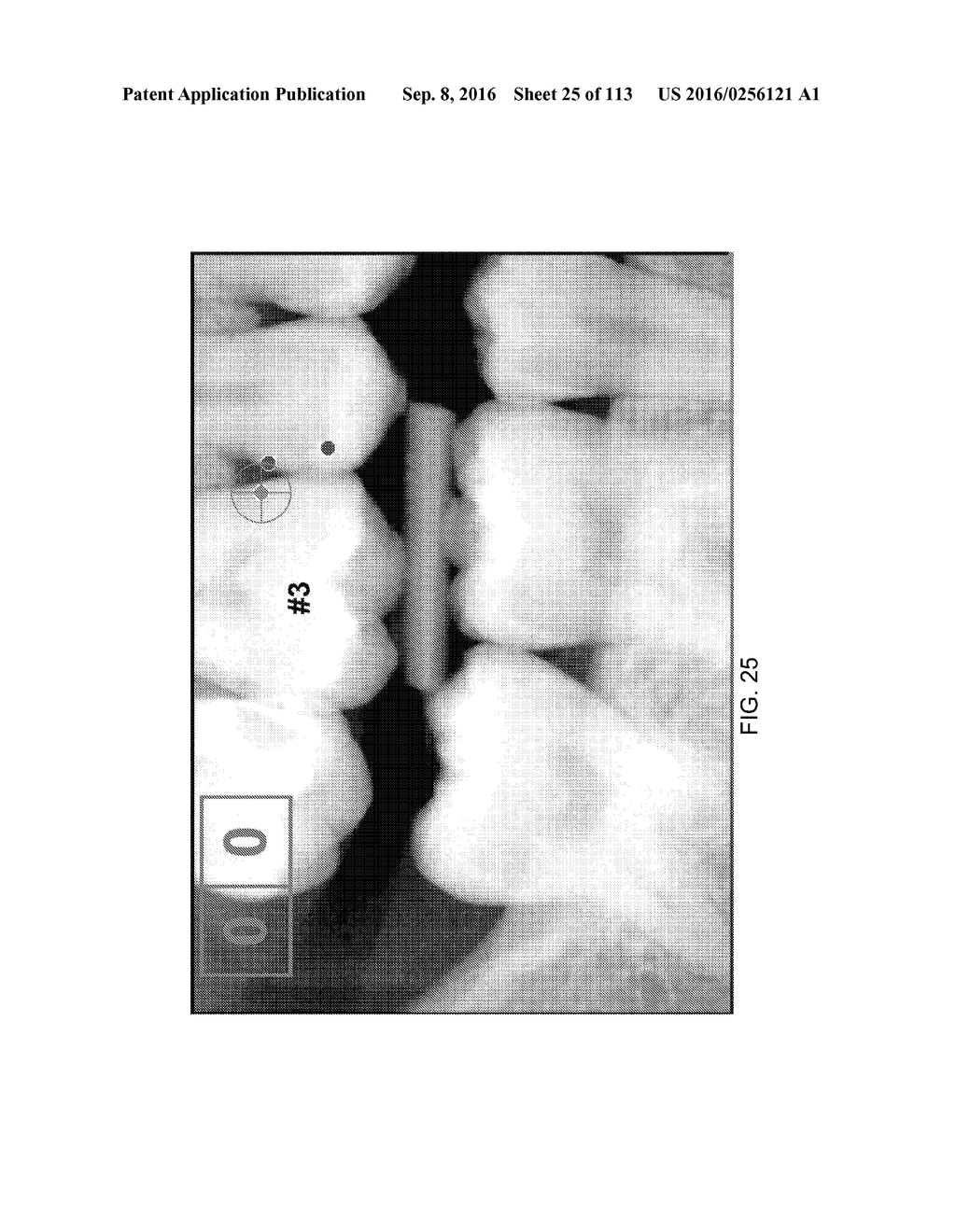 DIGITAL X-RAY DIAGNOSIS AND EVALUATION OF DENTAL DISEASE - diagram, schematic, and image 26