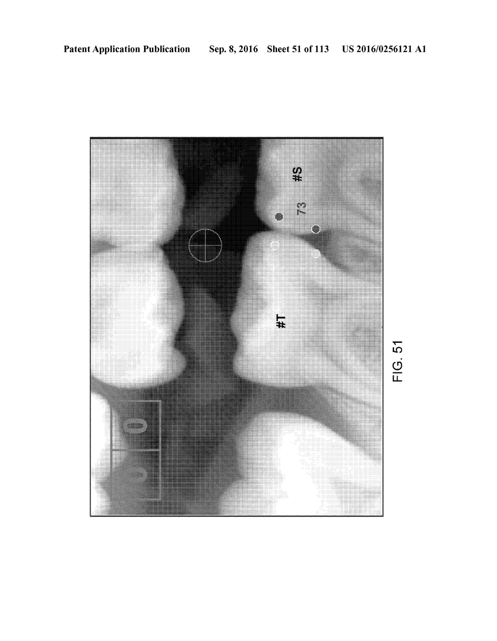 DIGITAL X-RAY DIAGNOSIS AND EVALUATION OF DENTAL DISEASE - diagram, schematic, and image 52