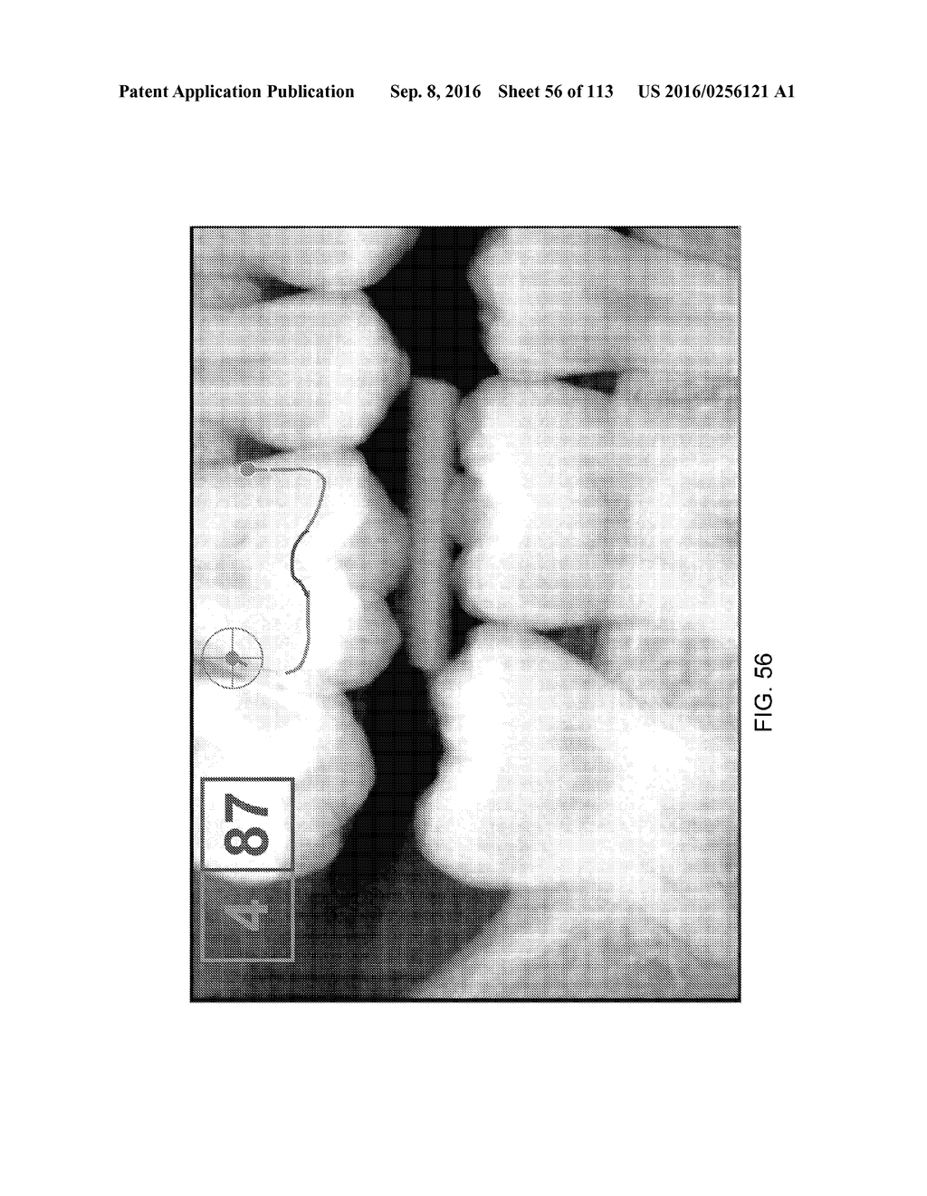 DIGITAL X-RAY DIAGNOSIS AND EVALUATION OF DENTAL DISEASE - diagram, schematic, and image 57