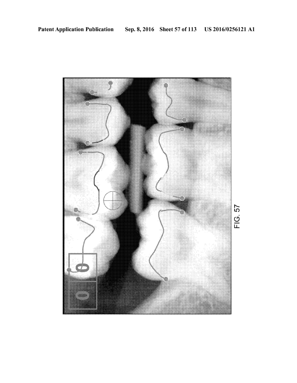 DIGITAL X-RAY DIAGNOSIS AND EVALUATION OF DENTAL DISEASE - diagram, schematic, and image 58