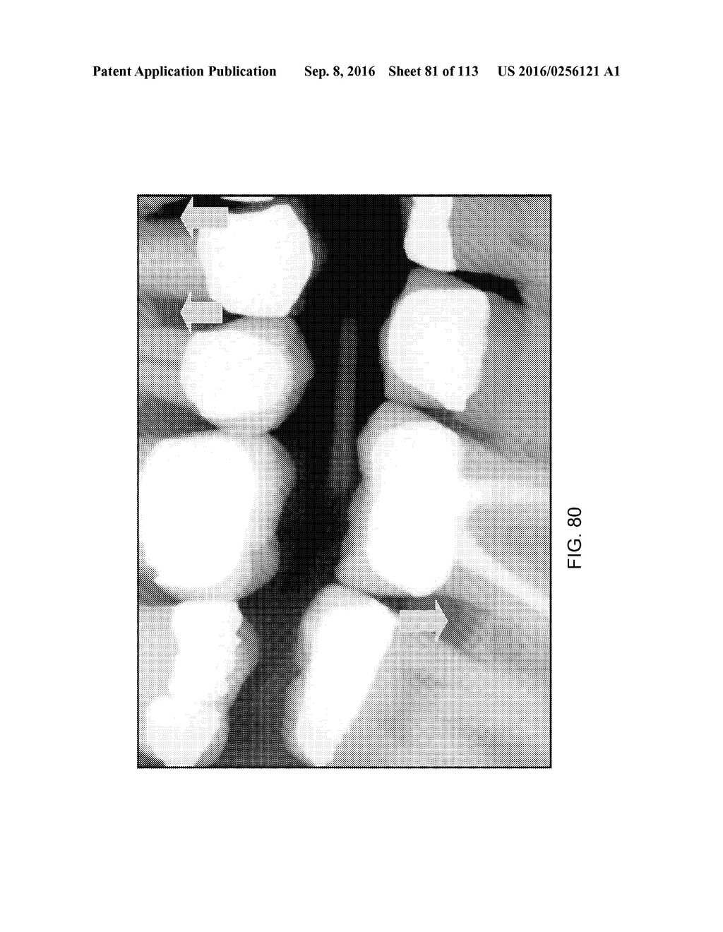 DIGITAL X-RAY DIAGNOSIS AND EVALUATION OF DENTAL DISEASE - diagram, schematic, and image 82