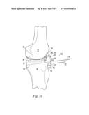 BONE RESECTION APPARATUS AND METHOD FOR KNEE SURGERY diagram and image