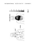 NERVE STIMULATION SYSTEMS VIA ENDOVASCULAR LEADS diagram and image