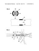 COMBINED VAGUS-PHRENIC NERVE STIMULATION DEVICE diagram and image