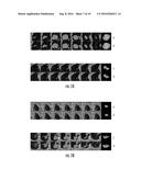 SYSTEMS AND METHODS FOR DIAGNOSING TUMORS IN A SUBJECT BY PERFORMING A     QUANTITATIVE ANALYSIS OF TEXTURE-BASED FEATURES OF A TUMOR OBJECT IN A     RADIOLOGICAL IMAGE diagram and image