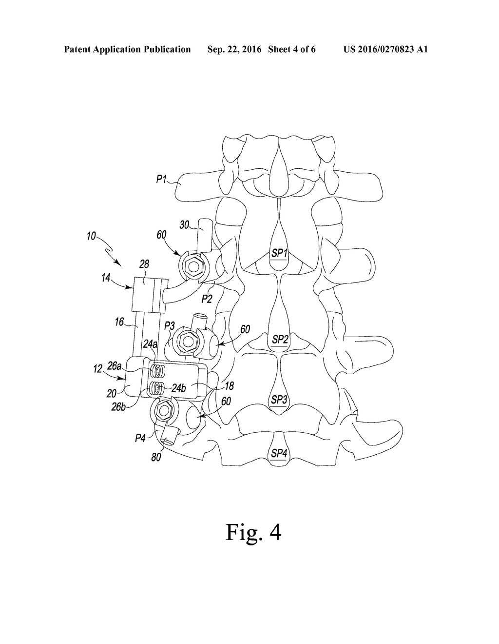 SUPPLEMENTARY SPINAL FIXATION/STABILIZATION APPARATUS WITH INTER-VERTEBRAL     CONNECTION - diagram, schematic, and image 05