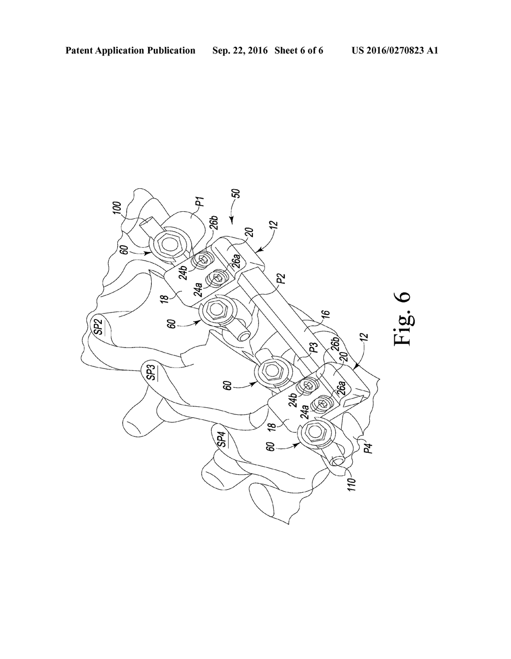 SUPPLEMENTARY SPINAL FIXATION/STABILIZATION APPARATUS WITH INTER-VERTEBRAL     CONNECTION - diagram, schematic, and image 07