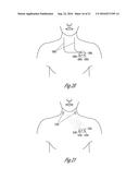 AUTONOMIC MODULATION USING TRANSIENT RESPONSE WITH INTERMITTENT NEURAL     STIMULATION diagram and image