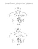 AUTONOMIC MODULATION USING TRANSIENT RESPONSE WITH INTERMITTENT NEURAL     STIMULATION diagram and image