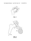 METHODS AND DEVICES FOR ACCESSING AND RETRACTING A CAPSULE OF A JOINT diagram and image