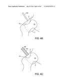 METHODS AND DEVICES FOR ACCESSING AND RETRACTING A CAPSULE OF A JOINT diagram and image