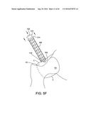 METHODS AND DEVICES FOR ACCESSING AND RETRACTING A CAPSULE OF A JOINT diagram and image