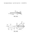 METHODS AND DEVICES FOR ACCESSING AND RETRACTING A CAPSULE OF A JOINT diagram and image