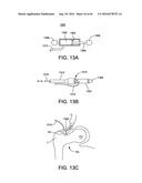 METHODS AND DEVICES FOR ACCESSING AND RETRACTING A CAPSULE OF A JOINT diagram and image