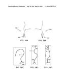 METHODS AND DEVICES FOR ACCESSING AND RETRACTING A CAPSULE OF A JOINT diagram and image