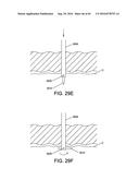 METHODS AND DEVICES FOR ACCESSING AND RETRACTING A CAPSULE OF A JOINT diagram and image