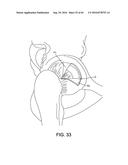 METHODS AND DEVICES FOR ACCESSING AND RETRACTING A CAPSULE OF A JOINT diagram and image