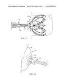 MEDICAL DEVICE FOR MODIFICATION OF LEFT ATRIAL APPENDAGE AND RELATED     SYSTEMS AND METHODS diagram and image