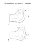 INTRAOPERATIVE DYNAMIC TRIALING diagram and image