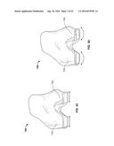 INTRAOPERATIVE DYNAMIC TRIALING diagram and image