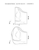 INTRAOPERATIVE DYNAMIC TRIALING diagram and image