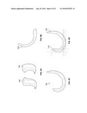 INTRAOPERATIVE DYNAMIC TRIALING diagram and image