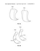 INTRAOPERATIVE DYNAMIC TRIALING diagram and image