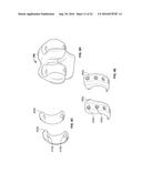 INTRAOPERATIVE DYNAMIC TRIALING diagram and image