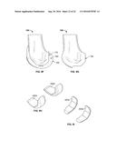 INTRAOPERATIVE DYNAMIC TRIALING diagram and image