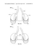 INTRAOPERATIVE DYNAMIC TRIALING diagram and image