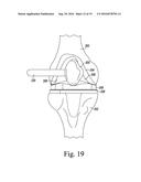 ORTHOPAEDIC SURGICAL INSTRUMENT SYSTEM FOR IMPLANTING A PROSTHETIC PATELLA     COMPONENT AND METHOD OF USE diagram and image