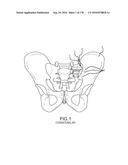 INTEGRATED ELECTROMAGNETIC IMPLANT GUIDANCE SYSTEMS AND METHODS OF USE FOR     SACROILIAC JOINT FUSION diagram and image